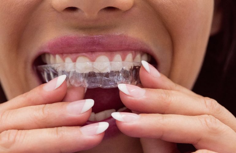 Ultimate Clear Braces Guide: Achieve A Straighter Smile