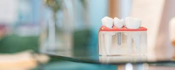 A Complete Guide To Dental Implants Tips